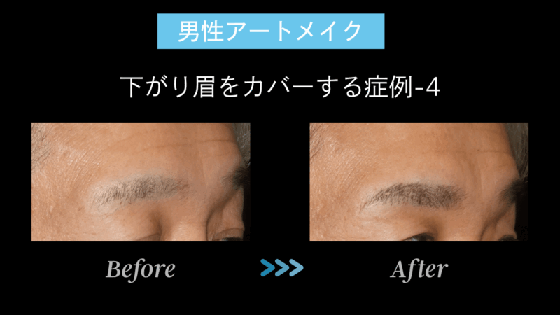 下がり眉症例-4